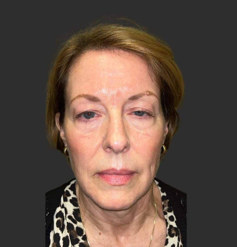 Lower Blepharoplasty - Before