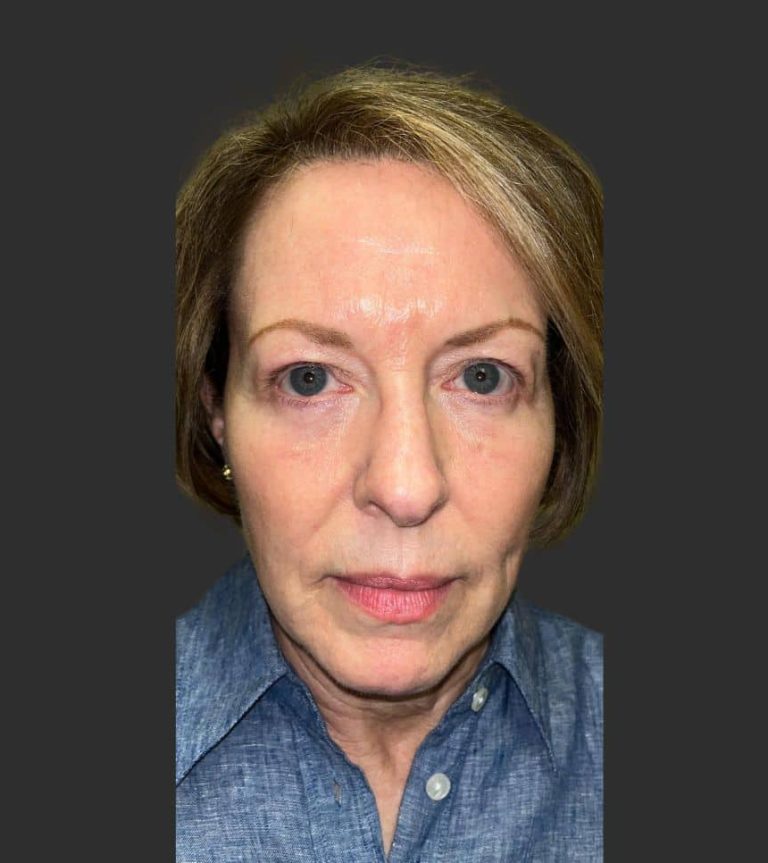 Lower Blepharoplasty - After