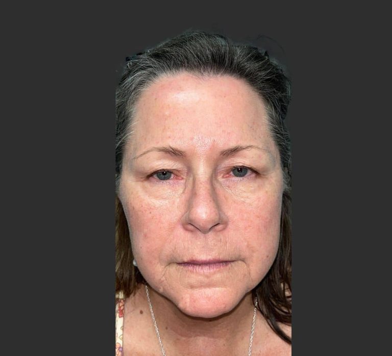 Upper Blepharoplasty - Before