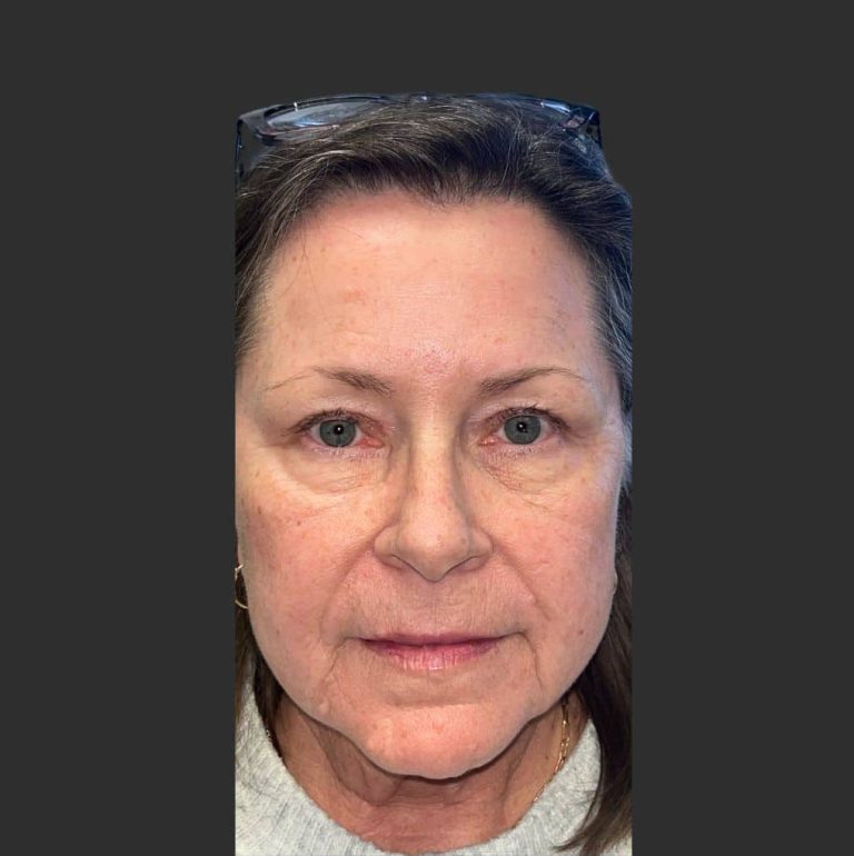 Upper Blepharoplasty - After